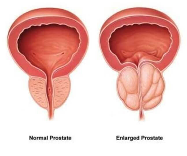 Enlarged prostate.jpg